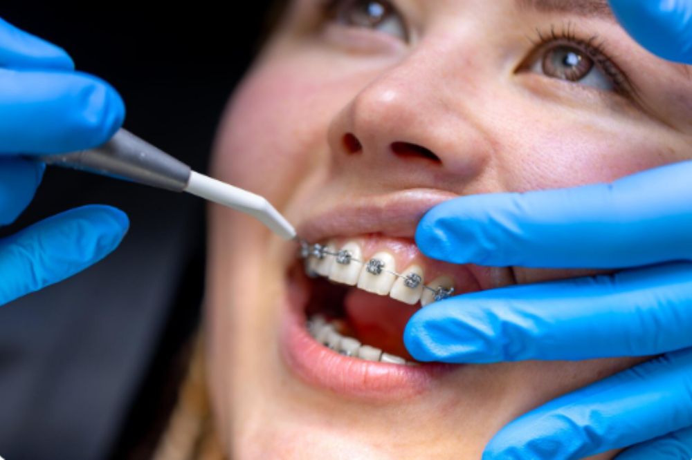 a lady is having orthodontic treatment
